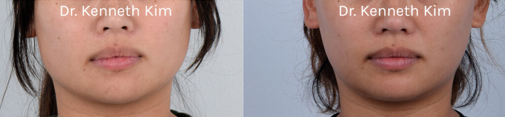 Female patient underwent chin augmentation surgery (using a chin implant) to achieve more balanced facial proportions. For those with wider mandibles (jawline), a less pronounced or recessed chin can make the face appear flat and broad. Chin augmentation surgery can add projection and definition to the chin, creating a more balanced and three-dimensional appearance. The post-op photos show how a subtle, natural-looking chin enhancement complements her facial features and makes the jaw appear less prominent.
   

