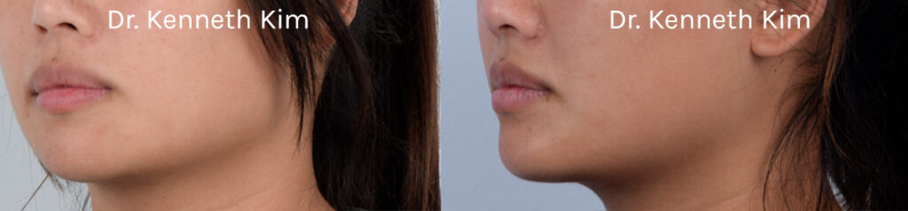 Female patient underwent chin augmentation surgery (using a chin implant) to achieve more balanced facial proportions. For those with wider mandibles (jawline), a less pronounced or recessed chin can make the face appear flat and broad. Chin augmentation surgery can add projection and definition to the chin, creating a more balanced and three-dimensional appearance. The post-op photos show how a subtle, natural-looking chin enhancement complements her facial features and makes the jaw appear less prominent.
   

