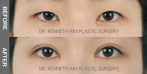 double eyelid surgery before after picture