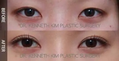 double eyelid surgery before after picture