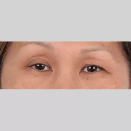Eyelid Surgery Before & After Patient #4728