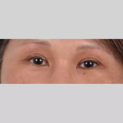 Eyelid Surgery Before & After Patient #4728