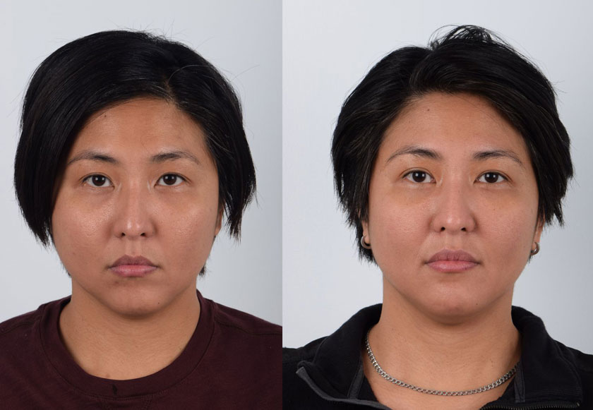 Asian female in her 30s underwent revision Asian upper blepharoplasty (previous eye surgery was performed elsewhere), epicanthoplasty, and chin implant surgeries. The revision double eyelid surgery created more even and balanced eyes. The addition of epicanthoplasty lengthened the inner corners of the eyes. The chin augmentation using a tailored silicone implant centered and evened out chin asymmetry.
   

