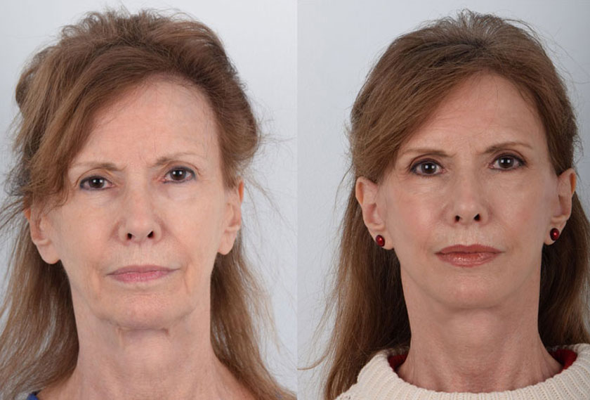 Facelift Before and After Photo Gallery