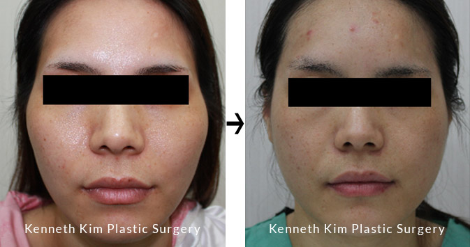 Facial Bone Contouring Before and After Front View