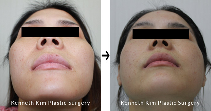 Facial Bone Contouring Before and After Front View