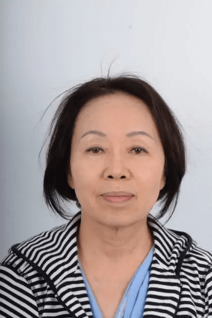 Facelift Before & After Patient #5018