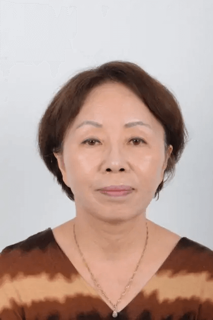 Facelift Before & After Patient #5018