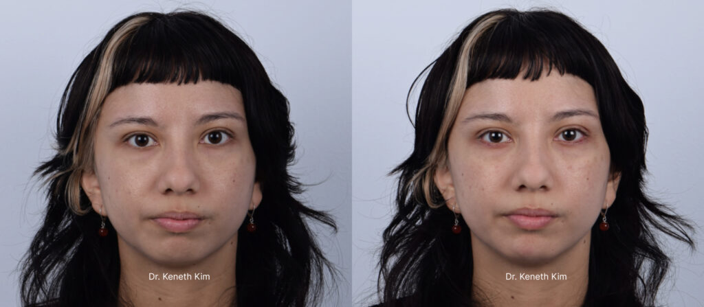Patient in her 20s wanted to accentuate her natural charm with subtle lower eyelid definition. Aegyo sal filler creates a soft, youthful, and 