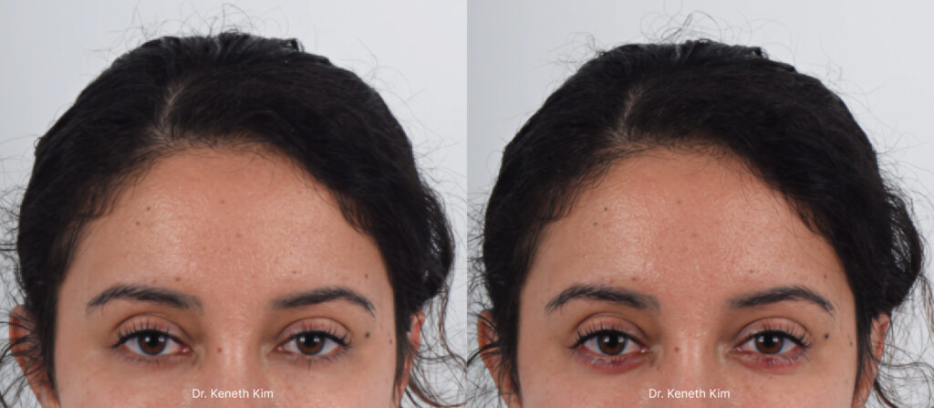 Aegyo-sal is a Korean term used to describe 'cute' fullness in the lower eyelid area, just below the lower lashes. This feature is most noticeable when smiling. This is a sought-after aesthetic in Korea as it denotes youthfulness and charm. Filler injections are a non-invasive way to add this desired volume. The procedure is quick and results are immediate. The 'after' photo was taken immediately after the procedure, so there is some redness present, which will fade shortly. The lower eye fullness (aegyo sal) creates a more youthful appearance and subtly conveys a smiling expression.  
   


