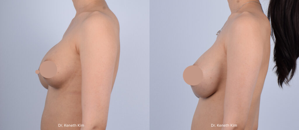 Female patient in her 20s underwent an awake revision breast augmentation to improve the appearance of her breasts. She wanted fuller volume with a smoother, more natural shape. Her prior surgery was performed elsewhere, and she specifically sought Dr. Kim for his awake approach to revision breast implant surgery. The revision breast augmentation was performed using only local anesthesia (no general anesthesia, no IV sedation, no intubation), allowing her to remain fully awake and comfortable throughout the procedure. Dr. Kim's awake breast augmentation avoids the risks associated with general anesthesia, including life-threatening blood clots and memory loss. His minimal bleeding method significantly minimizes the risk of capsular contracture, a condition where scar tissue causes the breast to harden and distort. His approach leads to faster recovery, minimal downtime, and more natural-looking, softer results. Dr. Kim's advanced breast technique includes creating an internal bra using the patient's own tissue to support the implants, improving long-term results and breast shape.  
   

