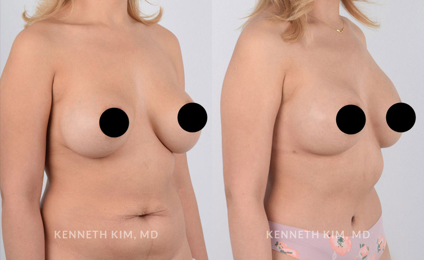 Female in her 30s underwent a mommy makeover which included breast augmentation and tummy tuck surgeries. Note the after photos were taken 3 months after surgery. The breast augmentation elevated the breasts creating a perkier, fuller, and more youthful shape. The tummy tuck (abdominoplasty) reshaped the abdominal area creating a toned and flat stomach.