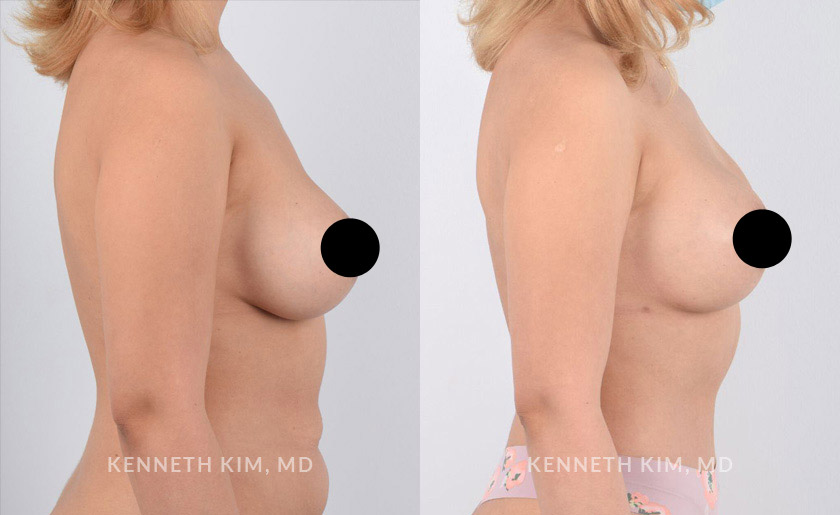 Female in her 30s underwent a mommy makeover which included breast augmentation and tummy tuck surgeries. Note the after photos were taken 3 months after surgery. The breast augmentation elevated the breasts creating a perkier, fuller, and more youthful shape. The tummy tuck (abdominoplasty) reshaped the abdominal area creating a toned and flat stomach.