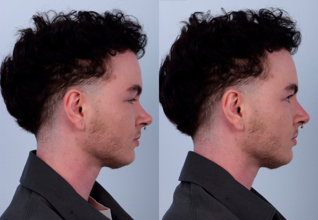 This patient received non-surgical rhinoplasty with filler injections to transform a curved, ski slope nose bridge into a straighter nasal bridge. This is a non-invasive procedure with no downtime and immediate results. Dr. Kim used filler injections to enhance the dorsum, creating a straighter, more linear nose shape. The result is very natural-looking and balanced with his facial features. The after photos were taken immediately after the non-surgical procedure. The post-op photos show how a precise, well-placed injection by Dr. Kim can produce notable results.
   

