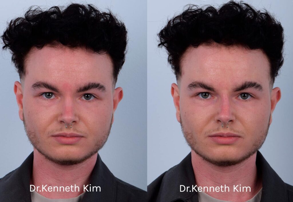 This patient received non-surgical rhinoplasty with filler injections to transform a curved, ski slope nose bridge into a straighter nasal bridge. This is a non-invasive procedure with no downtime and immediate results. Dr. Kim used filler injections to enhance the dorsum, creating a straighter, more linear nose shape. The result is very natural-looking and balanced with his facial features. The after photos were taken immediately after the non-surgical procedure. The post-op photos show how a precise, well-placed injection by Dr. Kim can produce notable results.
   

