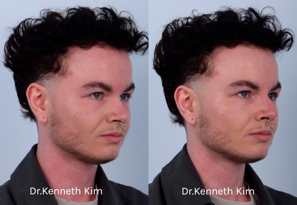 This patient received non-surgical rhinoplasty with filler injections to transform a curved, ski slope nose bridge into a straighter nasal bridge. This is a non-invasive procedure with no downtime and immediate results. Dr. Kim used filler injections to enhance the dorsum, creating a straighter, more linear nose shape. The result is very natural-looking and balanced with his facial features. The after photos were taken immediately after the non-surgical procedure. The post-op photos show how a precise, well-placed injection by Dr. Kim can produce notable results.
   

