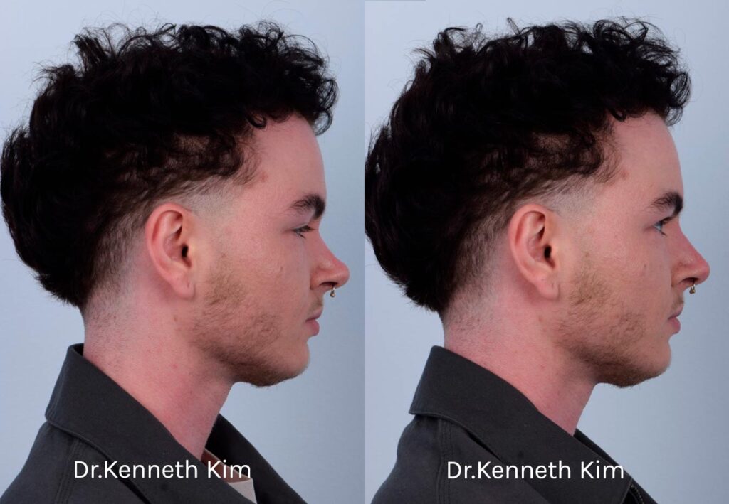 This patient received non-surgical rhinoplasty with filler injections to transform a curved, ski slope nose bridge into a straighter nasal bridge. This is a non-invasive procedure with no downtime and immediate results. Dr. Kim used filler injections to enhance the dorsum, creating a straighter, more linear nose shape. The result is very natural-looking and balanced with his facial features. The after photos were taken immediately after the non-surgical procedure. The post-op photos show how a precise, well-placed injection by Dr. Kim can produce notable results.
   

