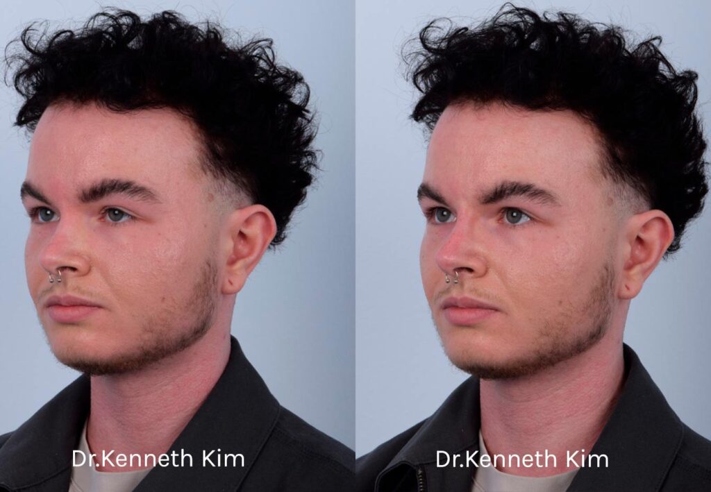 This patient received non-surgical rhinoplasty with filler injections to transform a curved, ski slope nose bridge into a straighter nasal bridge. This is a non-invasive procedure with no downtime and immediate results. Dr. Kim used filler injections to enhance the dorsum, creating a straighter, more linear nose shape. The result is very natural-looking and balanced with his facial features. The after photos were taken immediately after the non-surgical procedure. The post-op photos show how a precise, well-placed injection by Dr. Kim can produce notable results.
   

