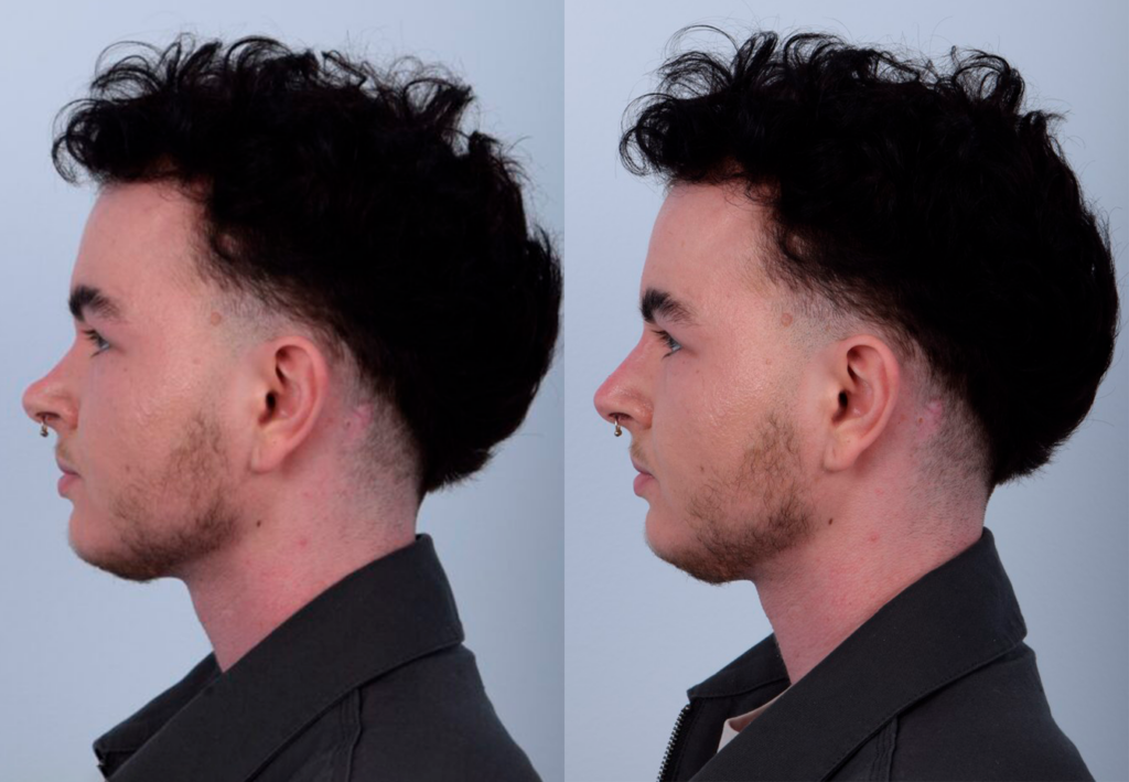 This patient received non-surgical rhinoplasty with filler injections to transform a curved, ski slope nose bridge into a straighter nasal bridge. This is a non-invasive procedure with no downtime and immediate results. Dr. Kim used filler injections to enhance the dorsum, creating a straighter, more linear nose shape. The result is very natural-looking and balanced with his facial features. The after photos were taken immediately after the non-surgical procedure. The post-op photos show how a precise, well-placed injection by Dr. Kim can produce notable results.
   

