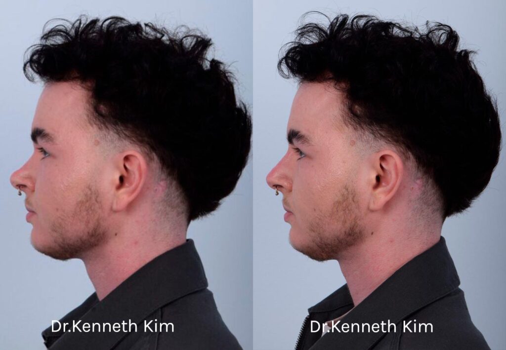 This patient received non-surgical rhinoplasty with filler injections to transform a curved, ski slope nose bridge into a straighter nasal bridge. This is a non-invasive procedure with no downtime and immediate results. Dr. Kim used filler injections to enhance the dorsum, creating a straighter, more linear nose shape. The result is very natural-looking and balanced with his facial features. The after photos were taken immediately after the non-surgical procedure. The post-op photos show how a precise, well-placed injection by Dr. Kim can produce notable results.
   


