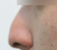 Asian male in his 30s with a down-turned, under-projected nose wanted a well-defined nose with a prominent tip. He received a subtle dorsal hump reduction to achieve a straighter and smooth nose bridge. Dr. Kim also used the patient’s septal cartilage (cartilage inside the nose) to elevate his nasal tip. The patient underwent awake rhinoplasty with local anesthesia which ensured a safe surgery and speedy recovery. The after photo shows a more refined and attractive nasal appearance.