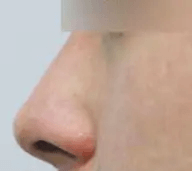 Nose Surgery Before & After Patient #3561