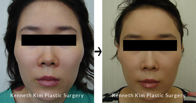 Oval-Shaped facial contour before and after image