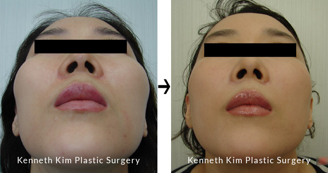 Oval-Shaped facial contour before and after image