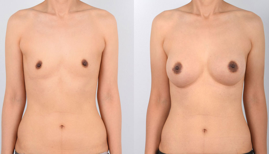 Asian Female, Breast Augmentation, Age:41-46