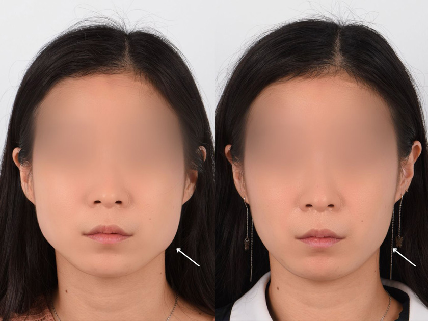 Non Surgical Jaw Reduction using Botulinum Toxin
   

