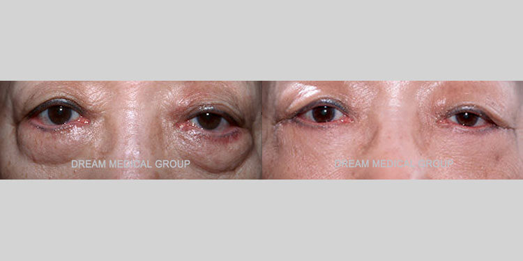 Female Asian patient in her 60s had significant under-eye bags and puffiness. The awake lower blepharoplasty (lower eyelid surgery) successfully tightened and smoothed the lower eye region. The after photo shows the dramatic improvement and transformation from fatigued and older appearing eyes to a refreshed and rejuvenated look. The patient received awake surgery with no pain or discomfort that resulted in the fastest recovery possible.
   


