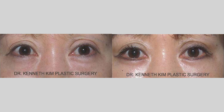 Awake lower eyelid surgery results for a female Asian patient in her 50s. The lower blepharoplasty procedure involved repositioning the fat in the lower eyelid to reduce the under-eye bags/bulge. Note the smoother, more taut contour of the lower eye region in the after photo.
   

