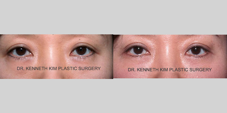 Asian female in her 40s had puffy under-eye bags that made her appear tired and older. She underwent lower eyelid surgery (lower blepharoplasty) where the fat in the lower eyes was repositioned. The after photo shows a smoother lower eye contour where the fat bulge or puffy eye bags are no longer visible, giving a more youthful and rested appearance
   

