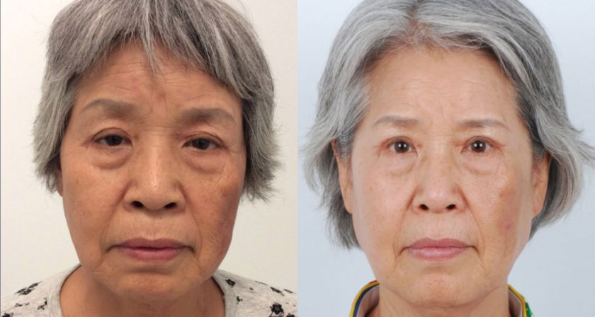 Asian female in her 60s had uneven and droopy eyelids (ptosis) making her appear sleepy and tired. She underwent revision Asian double eyelid surgery (prior eyelid surgery was performed elsewhere) and ptosis correction. The ptosis repair helped strengthen the weak eye-elevating muscle and evened out her eyelids. The ptosis correction in conjunction with Asian blepharoplasty improved her eyelid elevation and created more even double eyelid folds for an overall brighter, symmetrical appearance. She also received skin tightening laser treatment which helped her look more refreshed.
   

