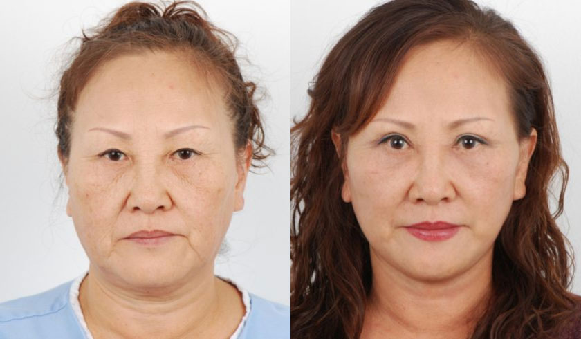 After receiving a combined awake facelift and double eyelid revision, this female patient in her 50s appeared rejuvenated and refreshed. The awake facelift procedure effectively lifted and tightened the facial sagging in the midface, jowls, jawline, and neck regions. The double eyelid revision created defined double eyelid folds that further opened her eyes. The combined procedures achieved natural-looking results and helped restore a more youthful facial appearance.
   

