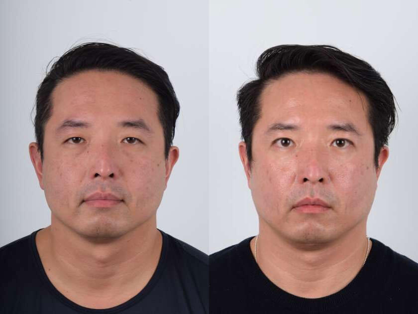 Asian male in his 40s had monolid eyes that made the eyelids appear heavy.  He underwent Asian double eyelid surgery (Asian upper blepharoplasty) where double eyelid folds were created. Double eyelid creases on males are typically created small. The result was natural-looking double eyelids. The eyes appear bigger and brighter with the iris more visible.
   

