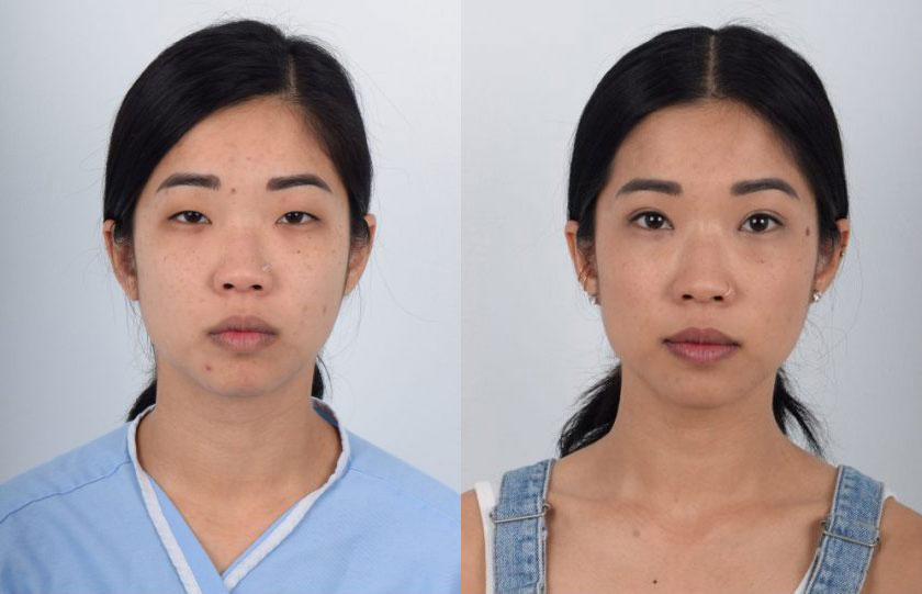 Asian female in her 20s with monolid eyes and ptosis (droop eyelid) underwent Asian double eyelid surgery (Asian blepharoplasty) and ptosis correction. The ptosis repair helped strengthen the weak eye elevating muscle and the double eyelid procedure created defined, balanced double eyelid folds. The after photo shows the transformation from eyes that appeared sleepy and tired to larger and refreshed.
   

