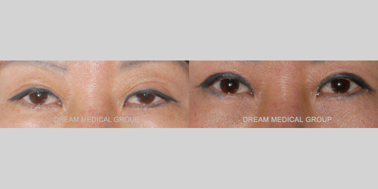 Asian patient in her 50s wanted to address her droopy eyelids that were causing her to appear tired and sleepy. The awake double eyelid revision and ptosis correction surgeries helped lift and balance her upper eyelids, restoring an alert, dynamic expression to her eyes.
   

