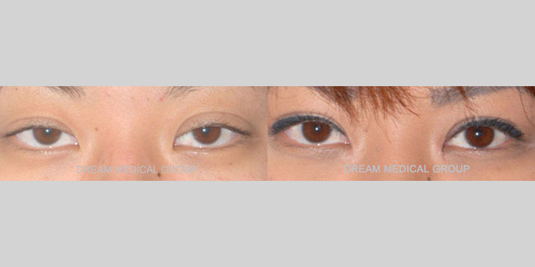 Asian female in her 30s after awake double eyelid revision and ptosis surgery. The ptosis procedure helped strengthen the weak eye elevating muscles which were causing the eyelids to droop, making the patient appear tired. Following the awake surgeries, the patient’s eyes appear more alert and refreshed.
   


