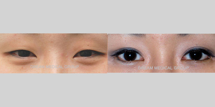 Results for a female Asian patient in her 30s after a combination of awake eyelid surgeries. She received double eyelid surgery (Asian blepharoplasty), epicanthoplasty, and lateral canthoplasty procedures. The after photo shows larger, brighter eyes with double eyelid folds that appear natural and enhance her beauty.
   

