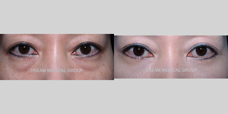 Asian woman in her 40s had puffy under-eye bags making the eyes appear tired and older. She received lower eyelid surgery (lower blepharoplasty) where the lower eyelid fat was repositioned. The after photo shows a tightened and smooth lower eye contour resulting in refreshed and youthful eyes.
   

