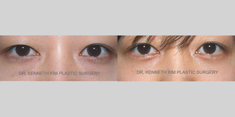 Awake dark circle removal surgery eliminated the hollow under-eye appearance for this female Asian patient in her 30s. Without the dark shadows below the eyes, she appeared more alert and refreshed.
   

