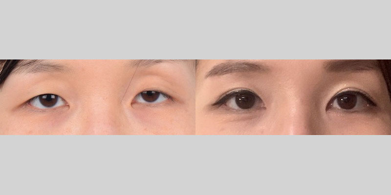 Asian female in her 20s with monolid eyes and ptosis (droopy eyelid) in her right eye wanted natural-looking double eyelid creases. She had Asian double eyelid surgery (Asian blepharoplasty) and unilateral ptosis correction to help achieve her desired results. Double eyelid surgery candidates who have eyelid ptosis should have ptosis repair surgery as well. Without ptosis correction, the double eyelid folds will appear uneven and can further exacerbate eyelid droopiness and hooding. Ptosis surgery will strengthen the weak eye elevating muscle so that the double eyelid folds will be balanced and the eyes appear bigger and clearer. The after photo shows improved eye symmetry, natural-looking double eyelid folds, and larger eyes where the iris is more visible. The procedures helped transform her eyes from tired to refreshed and appealing.
   

