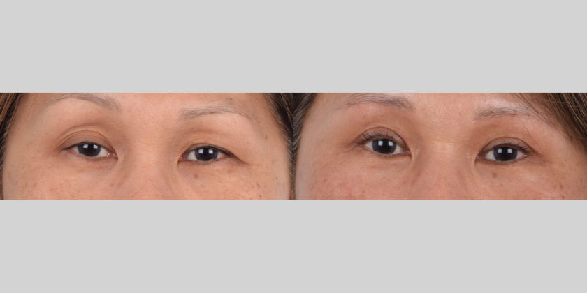 Asian female in her 40s with uneven eyes and eyelid hooding received unilateral ptosis correction, Asian double eyelid surgery, and a sub-brow lift. She had ptosis in her left eye with multiple eyelid folds and a hollow, sunken upper eyelid, while her right eye had lateral, outer eyelid hooding. The ptosis repair was performed on her left eye to strengthen the weak levator muscle which opened the eye and improved the hollowness of the upper eyelid. The double eyelid procedure created more even and defined eyelid folds. Lastly, the sub-brow lift targeted the drooping outer skin in the upper eye...
   

