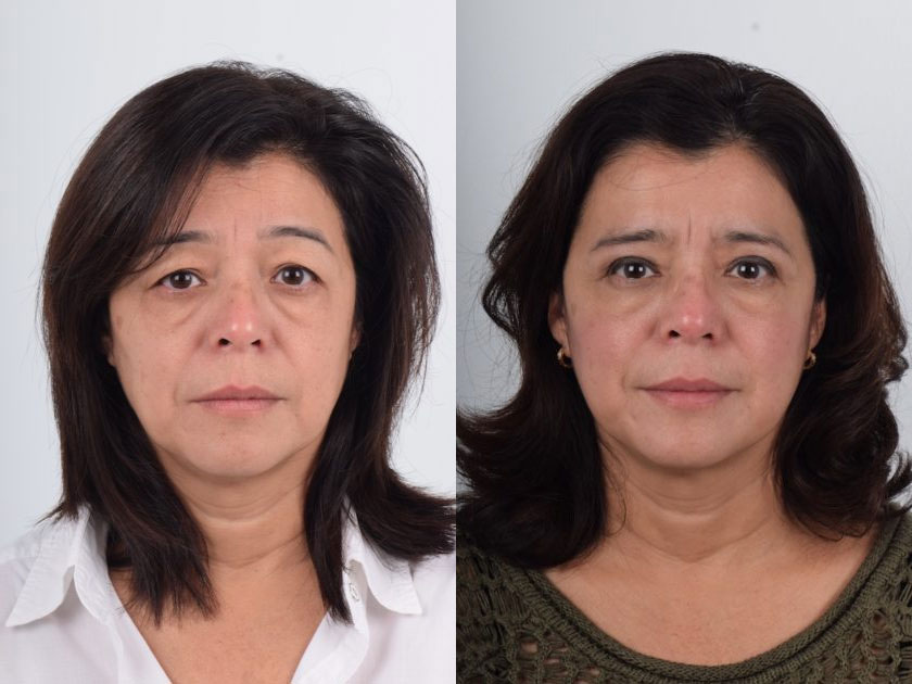 Asian female in her 40s with eyelid hooding received a sub-brow lift surgery. The sub-brow lift targets drooping or sagging upper eyes and involves removing the excess heavy skin below the eyebrow and lifting the underlying muscle. This resulted in tightened upper eyes and improved eyelid hooding so that the double eyelid folds became more visible. The eyebrow position remained unchanged. The surgery transformed tired and sleepy eyes into a brighter and youthful appearance.
   

