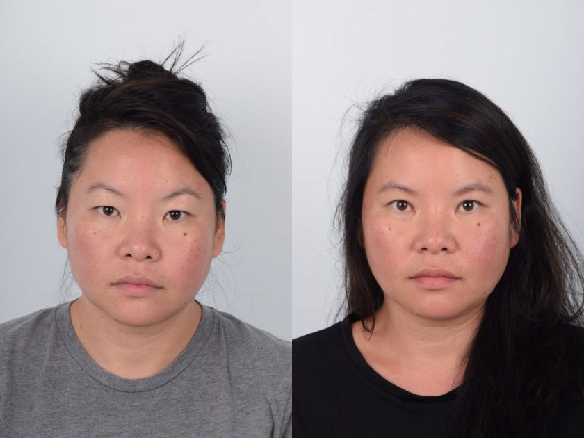 Asian female in her 30s with puffy upper eyes and eyelid hooding underwent a sub-brow lift surgery. The procedure is performed by making an incision at the lower portion of the eyebrow, removing excess skin just above the eyelid, and lifting the underlying muscle, all without changing the position of the eyebrows. The after photo shows smooth, less heavy upper eyelids and improved eyelid hooding.