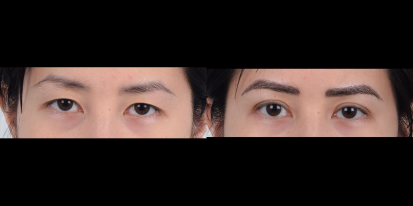 Asian female in her 30s with monolid eyes underwent Asian double eyelid surgery (Asian upper blepharoplasty). The after photo shows natural-looking, defined double eyelid folds that give the appearance of softer and more open eyes.
   

