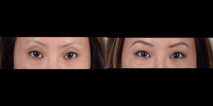 Asian female in her 40s underwent lateral canthoplasty eyelid surgery to reshape and elongate the outer corners of her eyes. Lateral canthoplasty is very effective for eyes that need horizontal enlargement. Opening the eyes wider helps make the face appear more proportioned. The after photo shows more open, softer, and glamorous eyes.