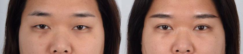 Asian Female, Eyelid Surgery, Age:31 - 35