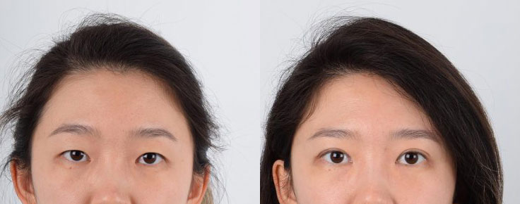 Asian female in her 20s with monolid and epicanthal folds underwent Asian double eyelid (Asian upper blepharoplasty) and epicanthoplasty surgeries. Based on the structure of the patient’s eyelids and the look they are trying to achieve, every double eyelid procedure is customized to the individual. Epicanthoplasty involves opening the inner corner of the eyes. The after photo shows defined double eyelid folds and elongated inner corners resulting in more proportioned eyes relative to her overall face.